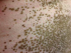 New treatment in the works for disfiguring skin disease, vitiligo