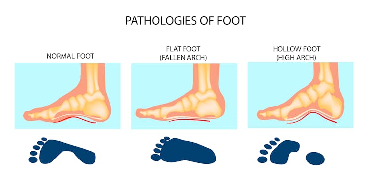 Children should spend more time to encourage a healthier foot structure