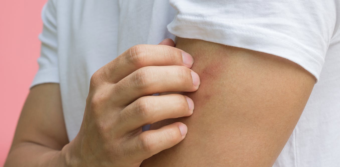 أعراض الأكزيما الشائعة