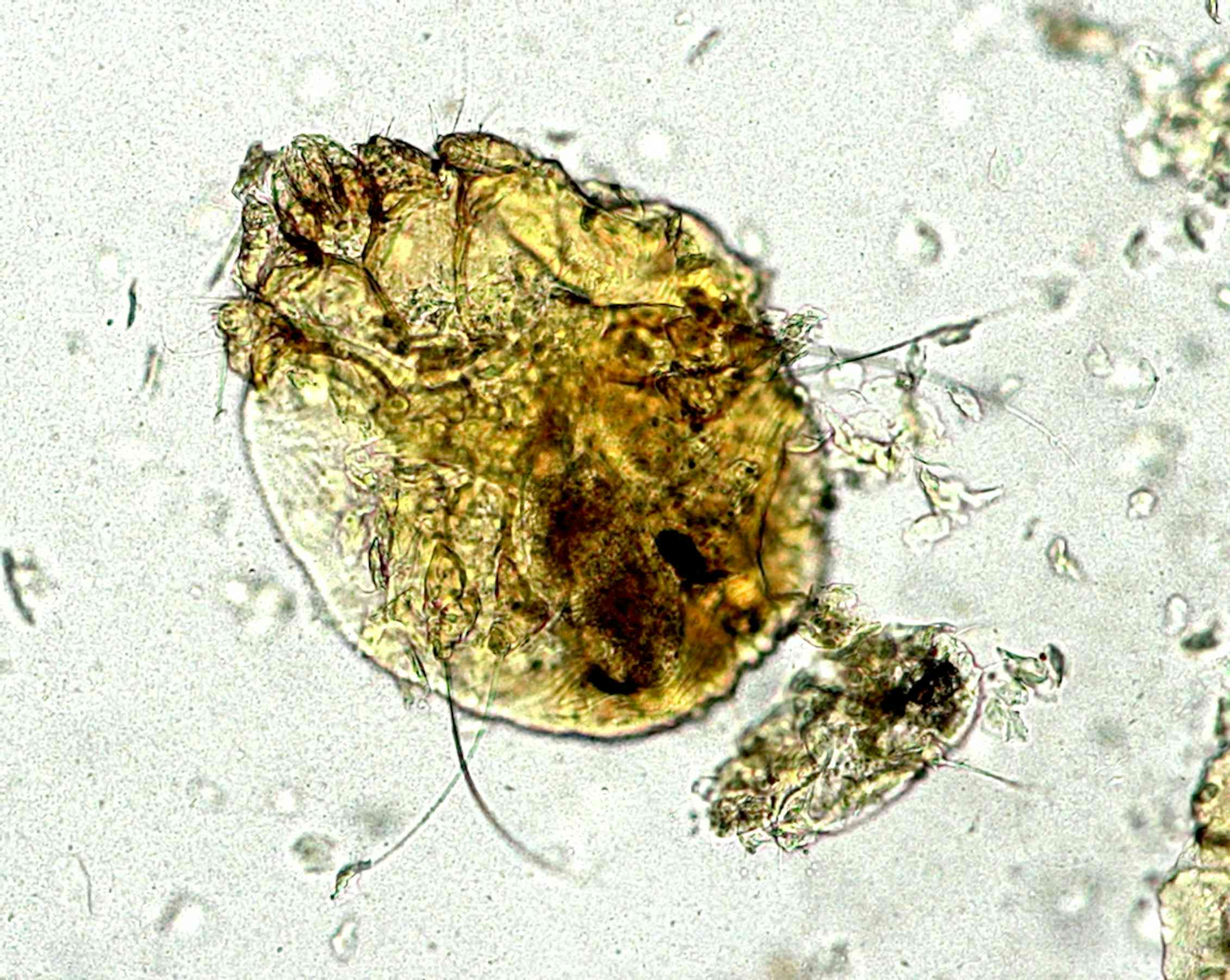 Le retour de la gale, une maladie contagieuse oubliée Le retour de la gale, une maladie contagieuse oubliée