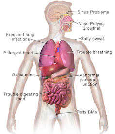 Discovering the ancient origin of cystic fibrosis, the most common genetic disease in Caucasians