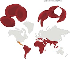 Discovering the ancient origin of cystic fibrosis, the most common genetic disease in Caucasians