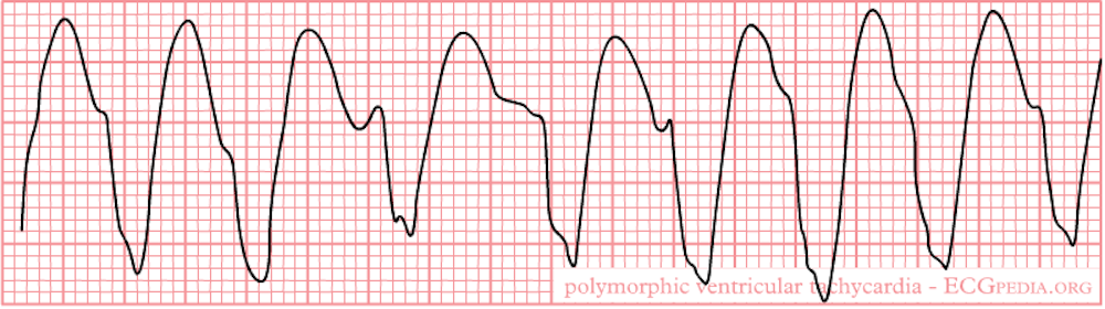 Monday S Medical Myth Flatlining Patients Can Be Shocked Back To Life