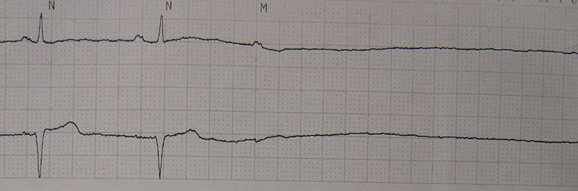 Monday's medical myth: flatlining patients can be shocked back to life