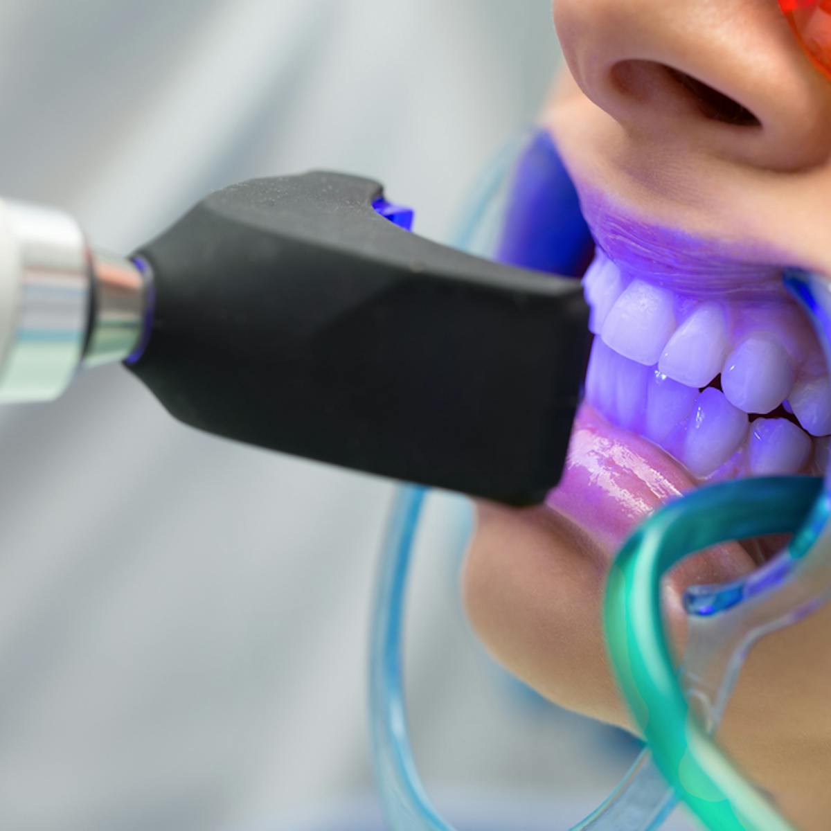 50 Shades Whiter What You Should Know About Teeth Whitening