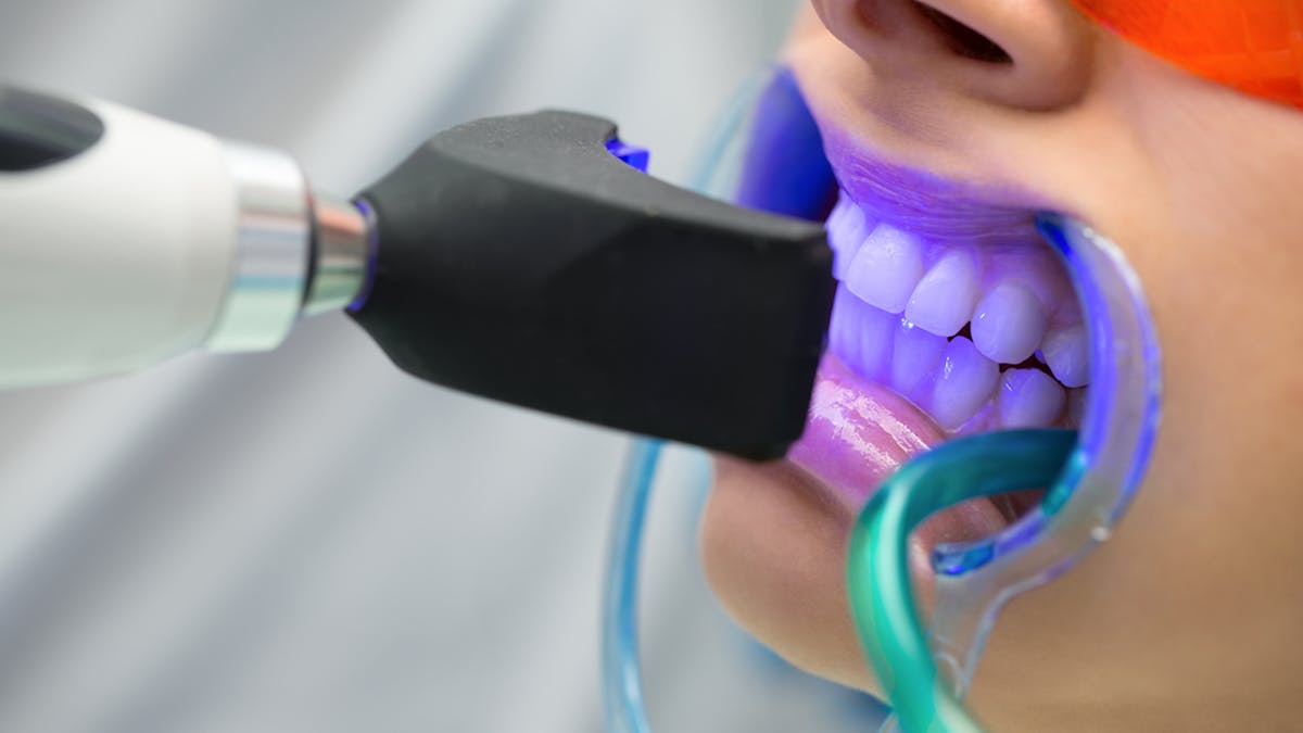 50 Shades Whiter What You Should Know About Teeth Whitening 50 Shades Whiter What You Should Know About Teeth Whitening