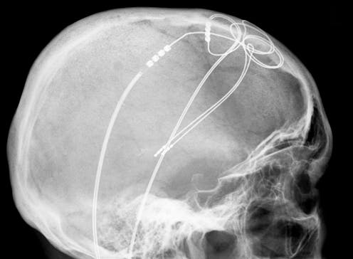 If Genes Dont Turn Off Brains Wiring >> Deep Brain Stimulation A Fix When The Drugs Don T Work If Genes Dont Turn Off Brains Wiring >> Deep Brain Stimulation A Fix When The Drugs Don T Work