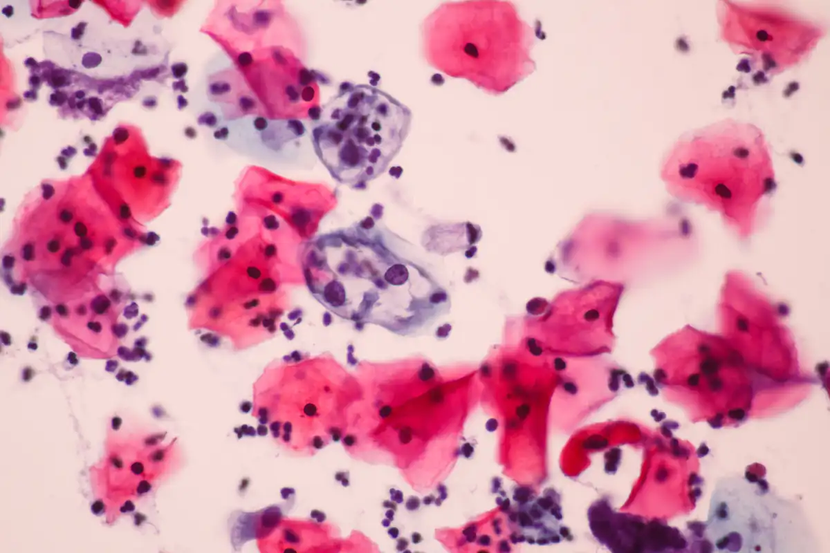 Delay In Replacing The Pap Smear With HPV Screening Is Costing Lives delay-in-replacing-the-pap-smear-with-hpv-screening-is-costing-lives
