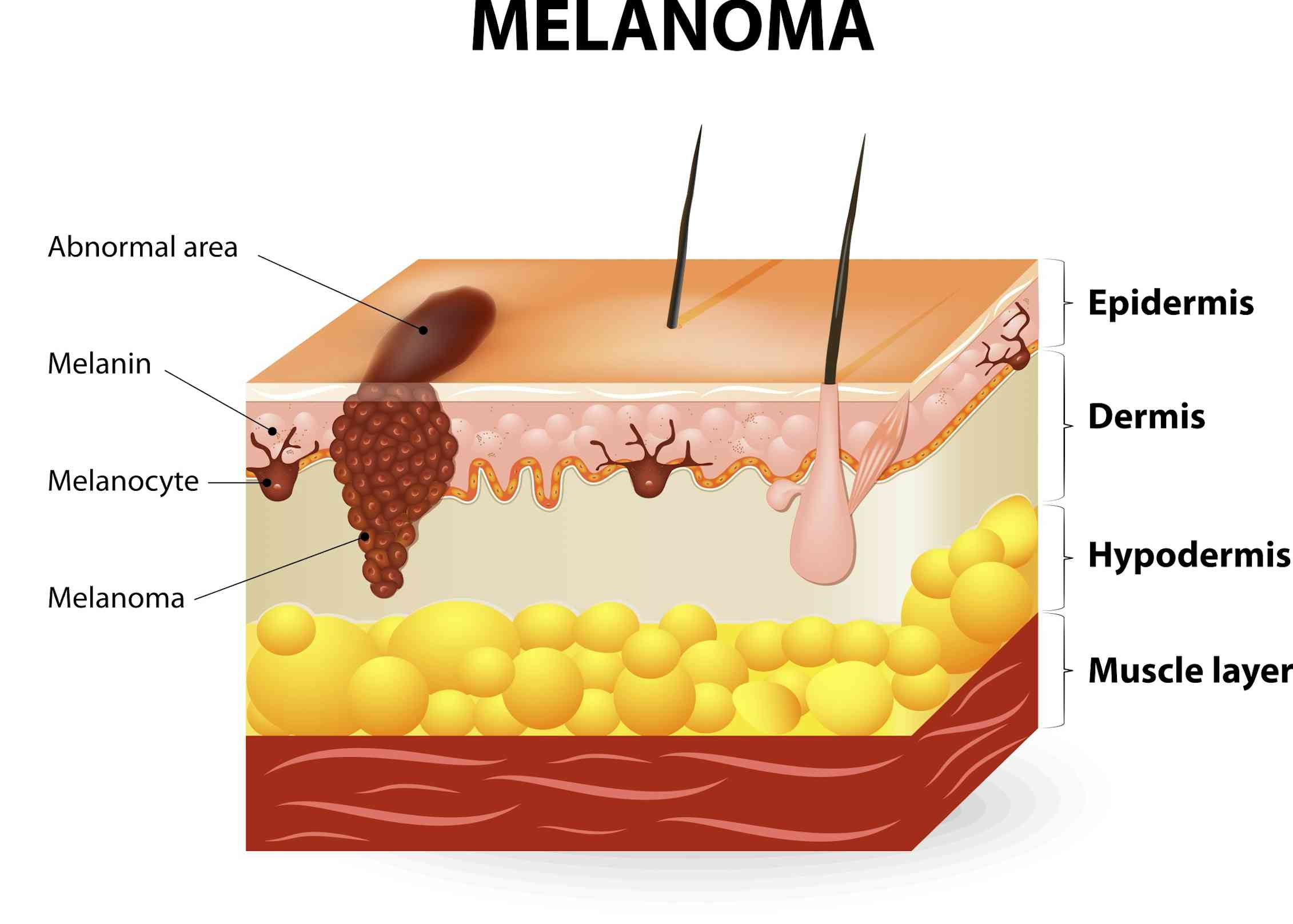 future research for melanoma