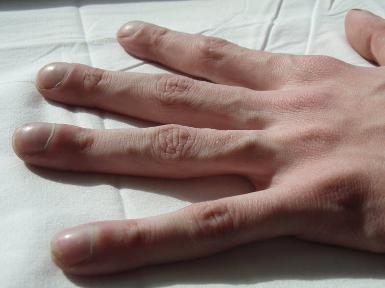 SYMPTOMS. Clubbing of the fingers is a common feature of Cystic Fibrosis. Jerry Nick, M.D./wikipedia, CC BY-SA