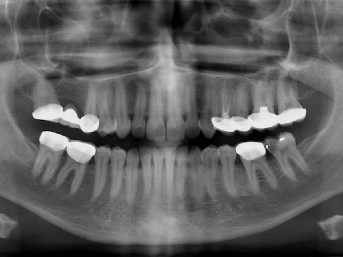 A Closer Look At How Crystal Meth Attacks Gums And Teeth