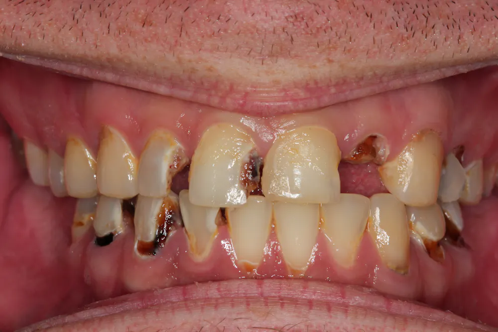 A closer look at how crystal meth attacks gums and teeth