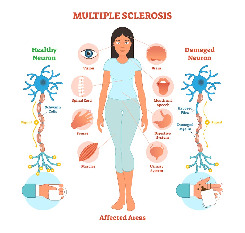 Multiple Sclerosis Causes, Symptoms, Diagnosis and Cure