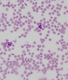 How our red blood cells keep evolving to fight malaria