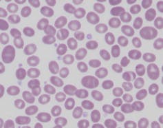 How our red blood cells keep evolving to fight malaria
