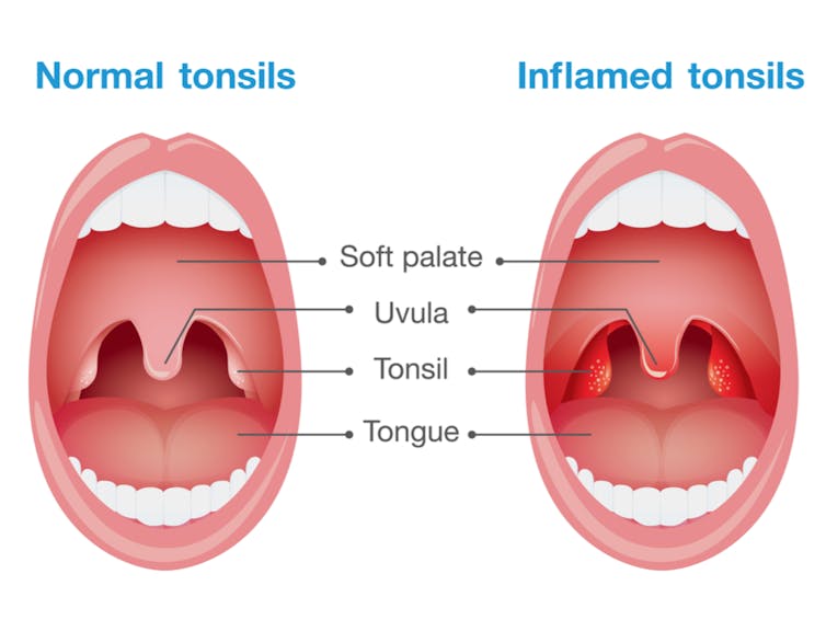 COMPARISON. Normal tonsils and inflamed tonsils. Image from solar22/Shutterstock