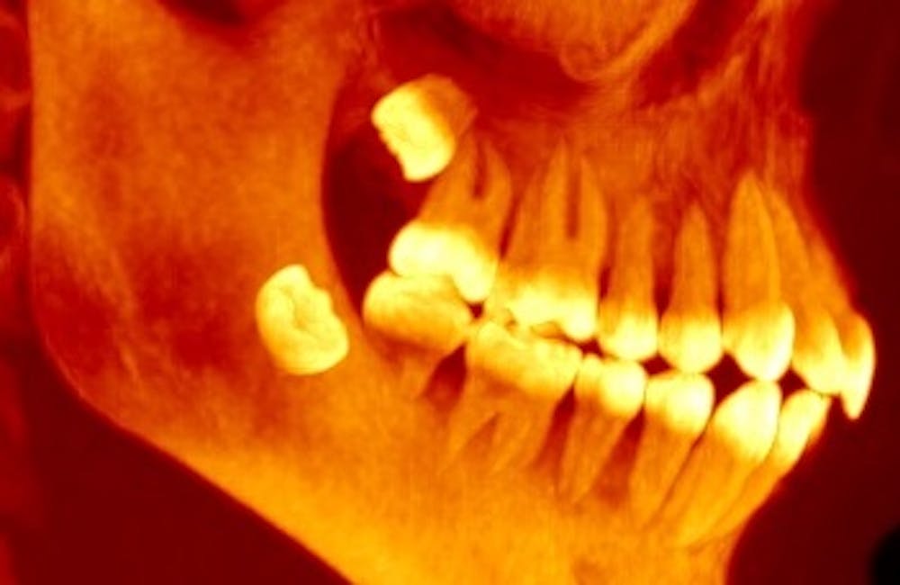 oral surgeon wisdom teeth katy tx