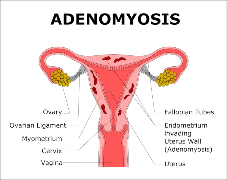 Adenomyosis causes pain, heavy periods and infertility but you've probably never heard of it