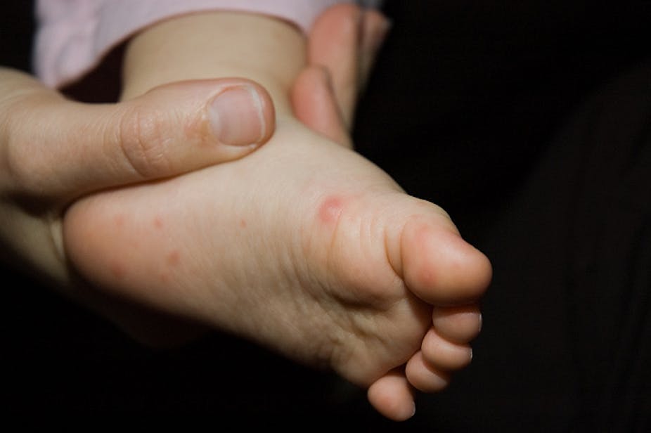 World First Hand Foot And Mouth Vaccine Developed