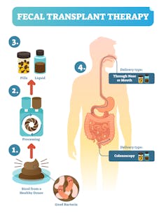 Fecal microbiome transplantation shows promise in treating colitis