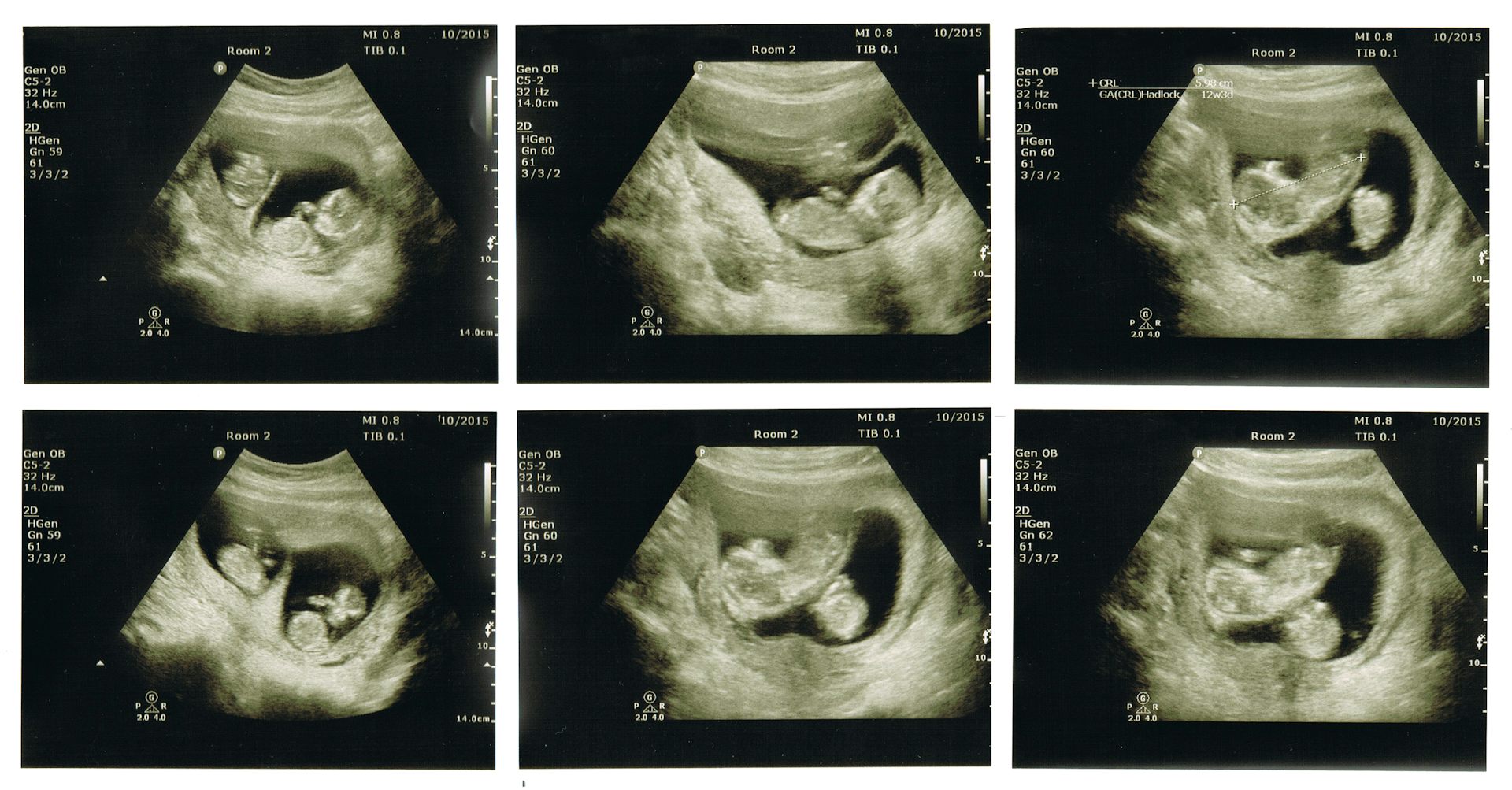 Как выглядит ребенок на 12 неделе беременности фото узи