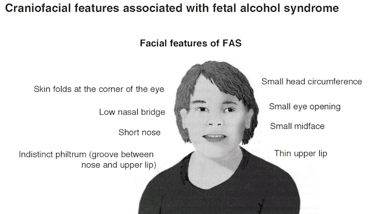 fetal alcohol syndrome statistics