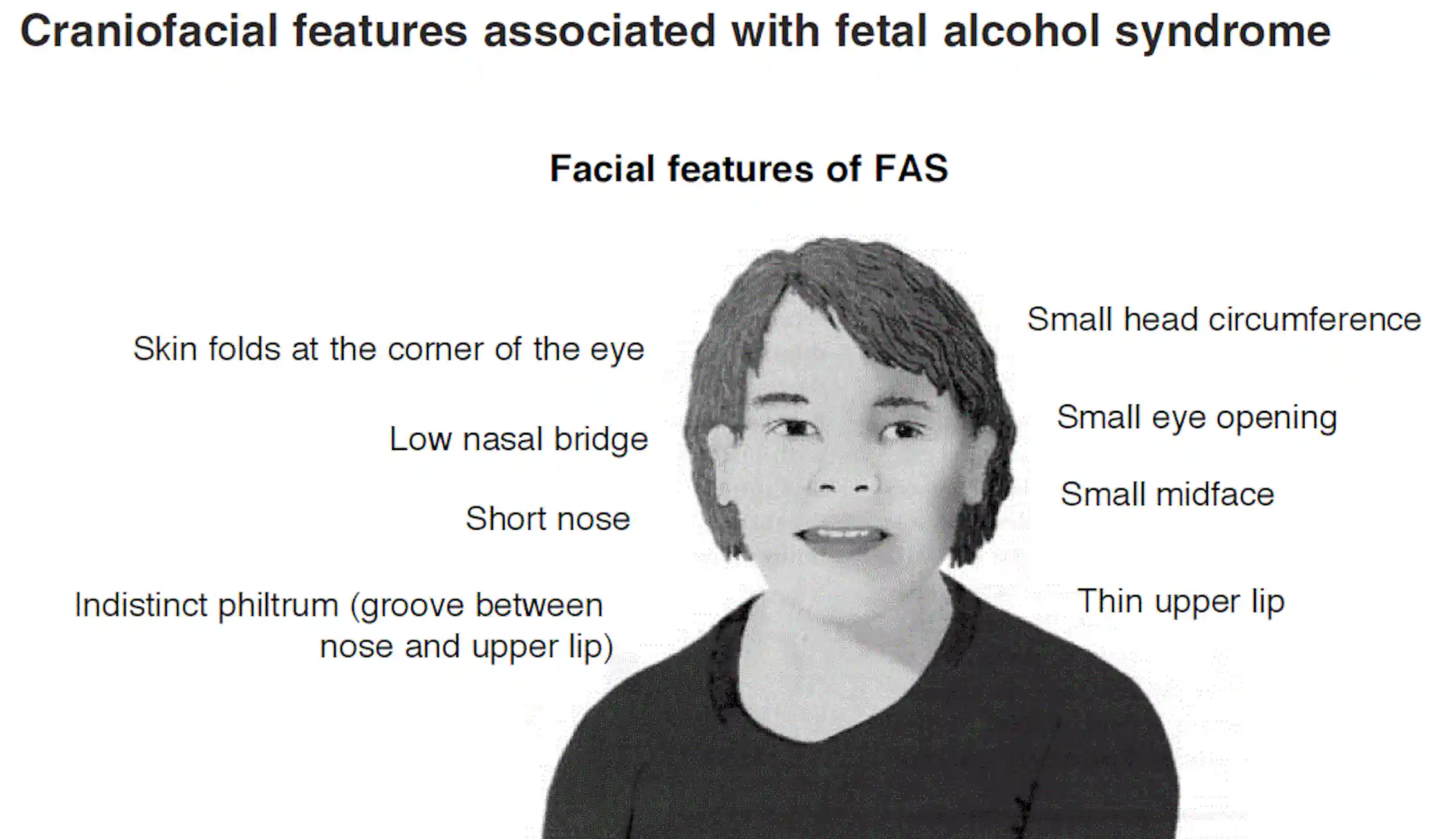 Up To 17 Of Children In The UK Could Have Symptoms Of Foetal Alcohol up-to-17-of-children-in-the-uk-could-have-symptoms-of-foetal-alcohol