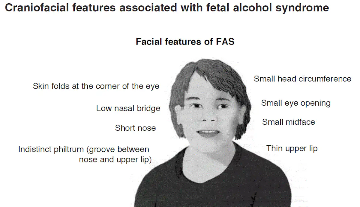 Up To 17 Of Children In The UK Could Have Symptoms Of Foetal Alcohol up-to-17-of-children-in-the-uk-could-have-symptoms-of-foetal-alcohol