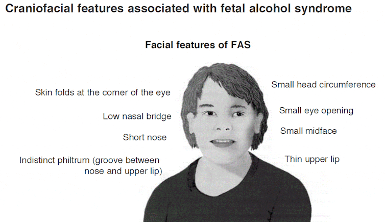 Up To 17 Of Children In The Uk Could Have Symptoms Of Foetal Alcohol Spectrum Disorder According To Latest Estimates Up To 17 Of Children In The Uk Could Have Symptoms Of Foetal Alcohol Spectrum Disorder According To Latest Estimates