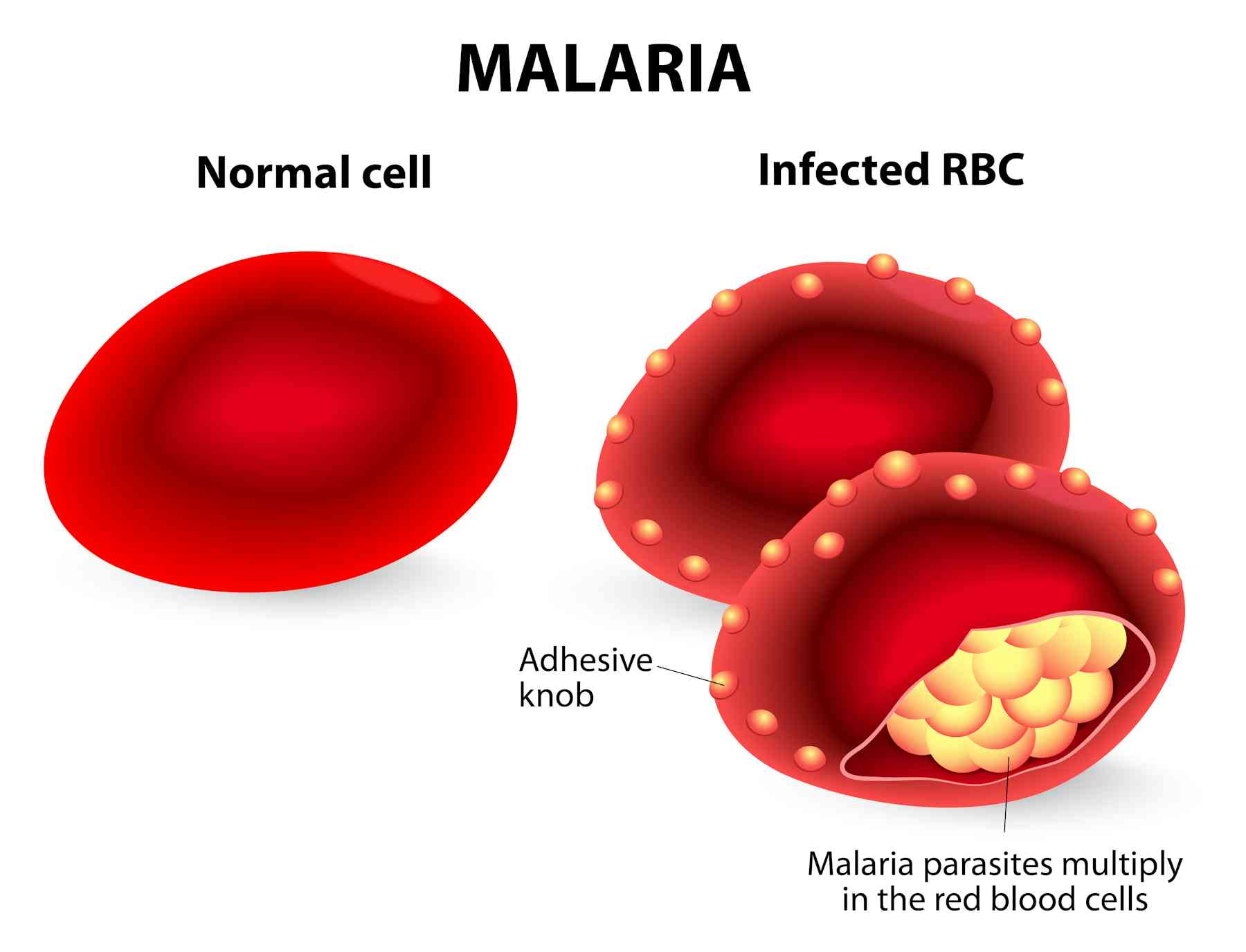 Малярия клетки. Разрушение эритроцитов малярийным плазмодием. Пораженный эритроцит плазмодием.