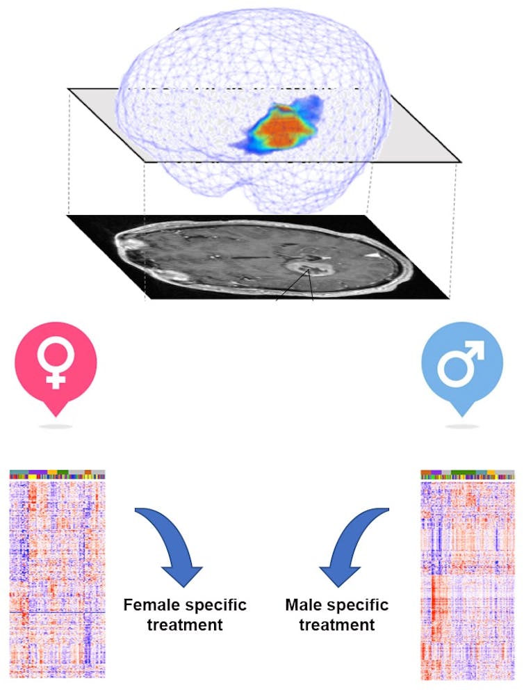 When it comes to brain tumors, a patient's sex matters