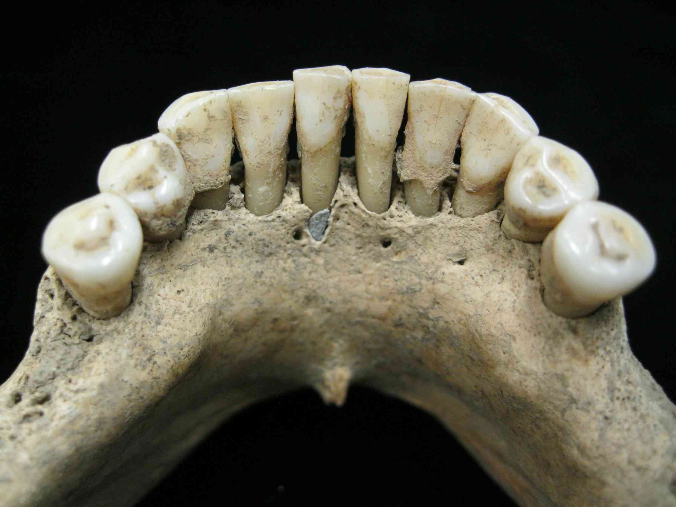 Средневековые зубные протезы