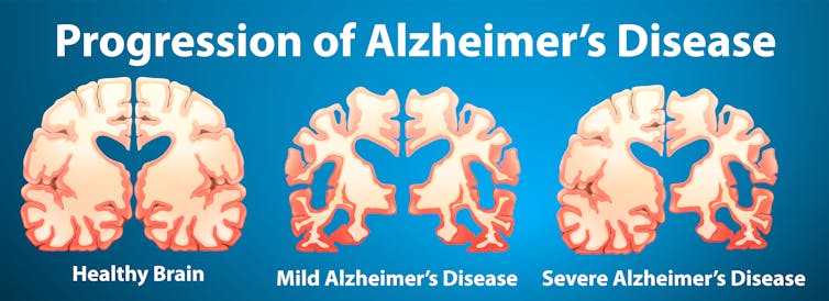 Time for a Manhattan Project on Alzheimer’s