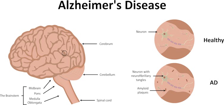 Time for a Manhattan Project on Alzheimer’s