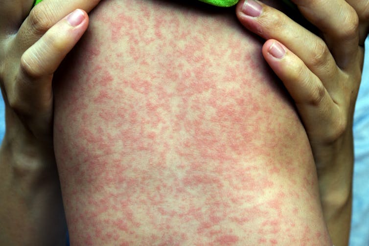 Why people born between 1966 and 1994 are at greater risk of measles – and what to do about it