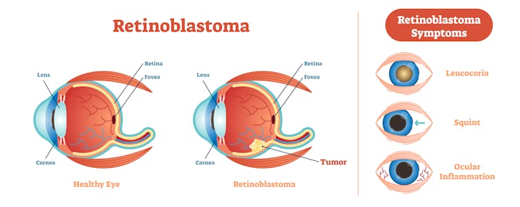 Potential treatment for eye cancer using tumor-killing virus