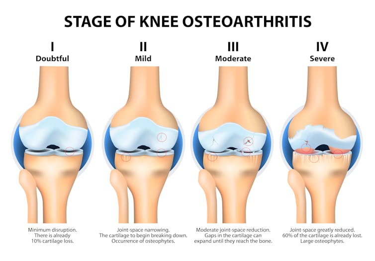 Stem cell treatments for arthritic knees are unproven, expensive and potentially dangerous