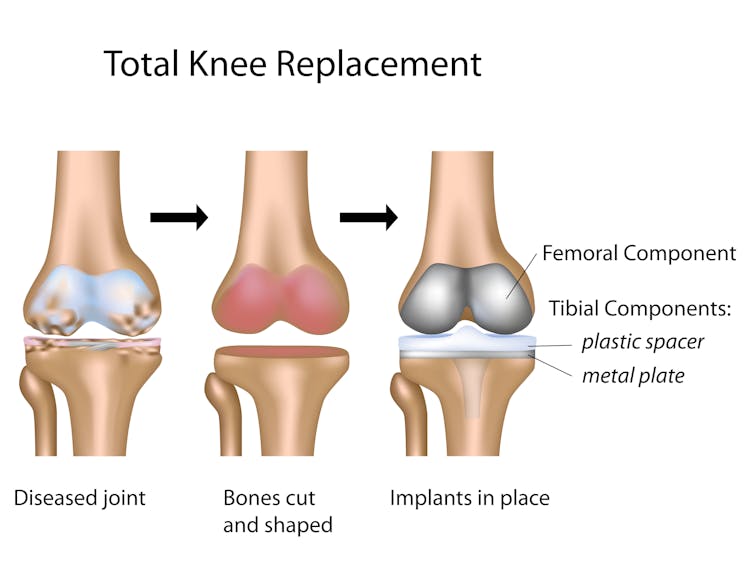 Stem cell treatments for arthritic knees are unproven, expensive and potentially dangerous