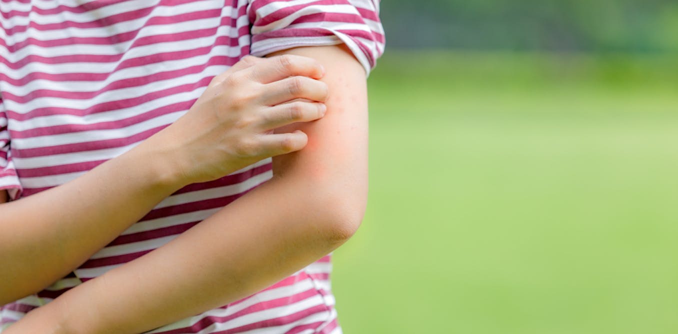 Health Check Why Do We Itch health-check-why-do-we-itch
