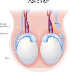 how does a vasectomy work and can it be reversed?