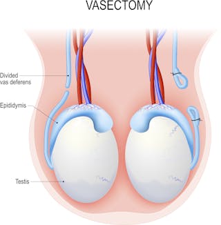 Explainer: how does a vasectomy work and can it be reversed?