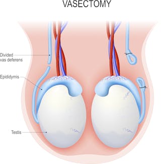 Explainer: How Does A Vasectomy Work And Can It Be Reversed?