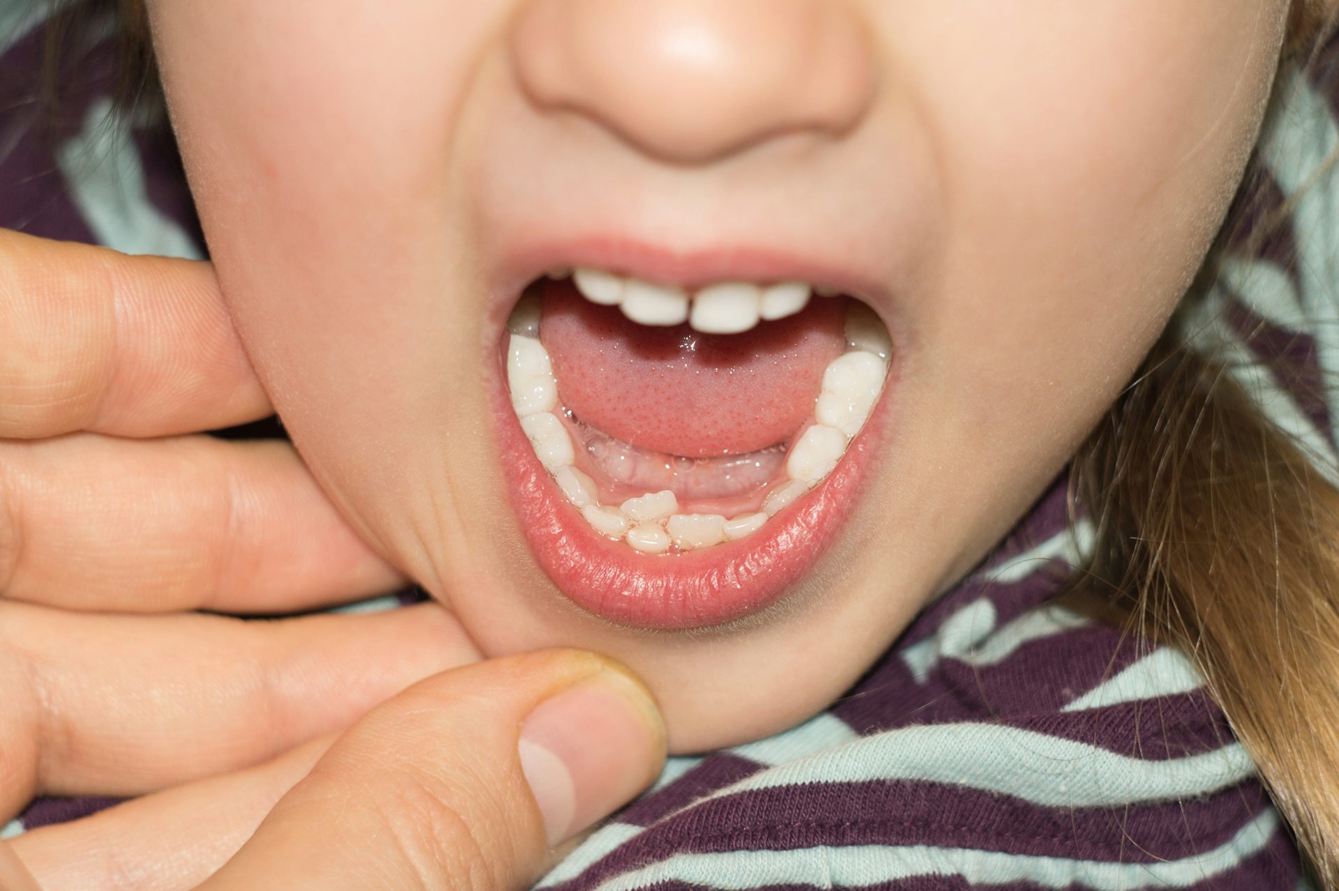 Фото молочных зубов во рту