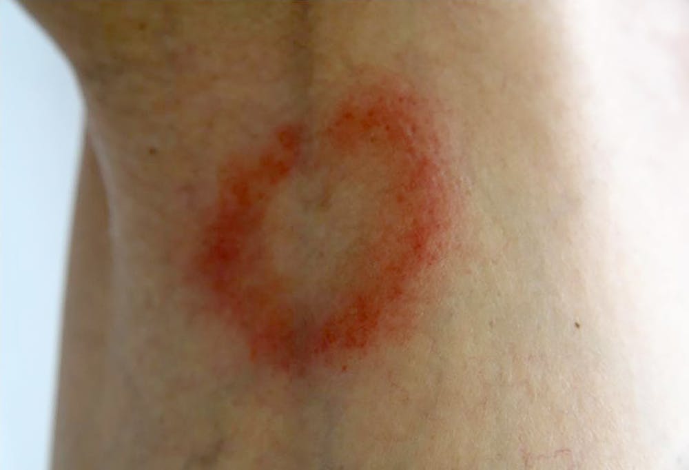 Les Tiques Sont De Retour Ce Qui Fonctionne Pour Eviter Les Piqures Les Tiques Sont De Retour Ce Qui Fonctionne Pour Eviter Les Piqures