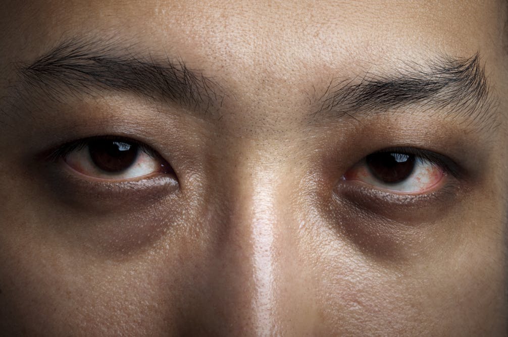 Dry eye disease and diabetes: new study reveals scale of issue and need for  screening