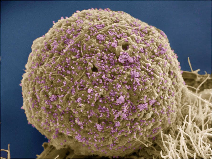 Фотографию вируса и названия. ВИЧ И СПИД под микроскопом. Вирусы под микроскопом. Вирус СПИДА под микроскопом. Вирус ВИЧ под микроскопом.