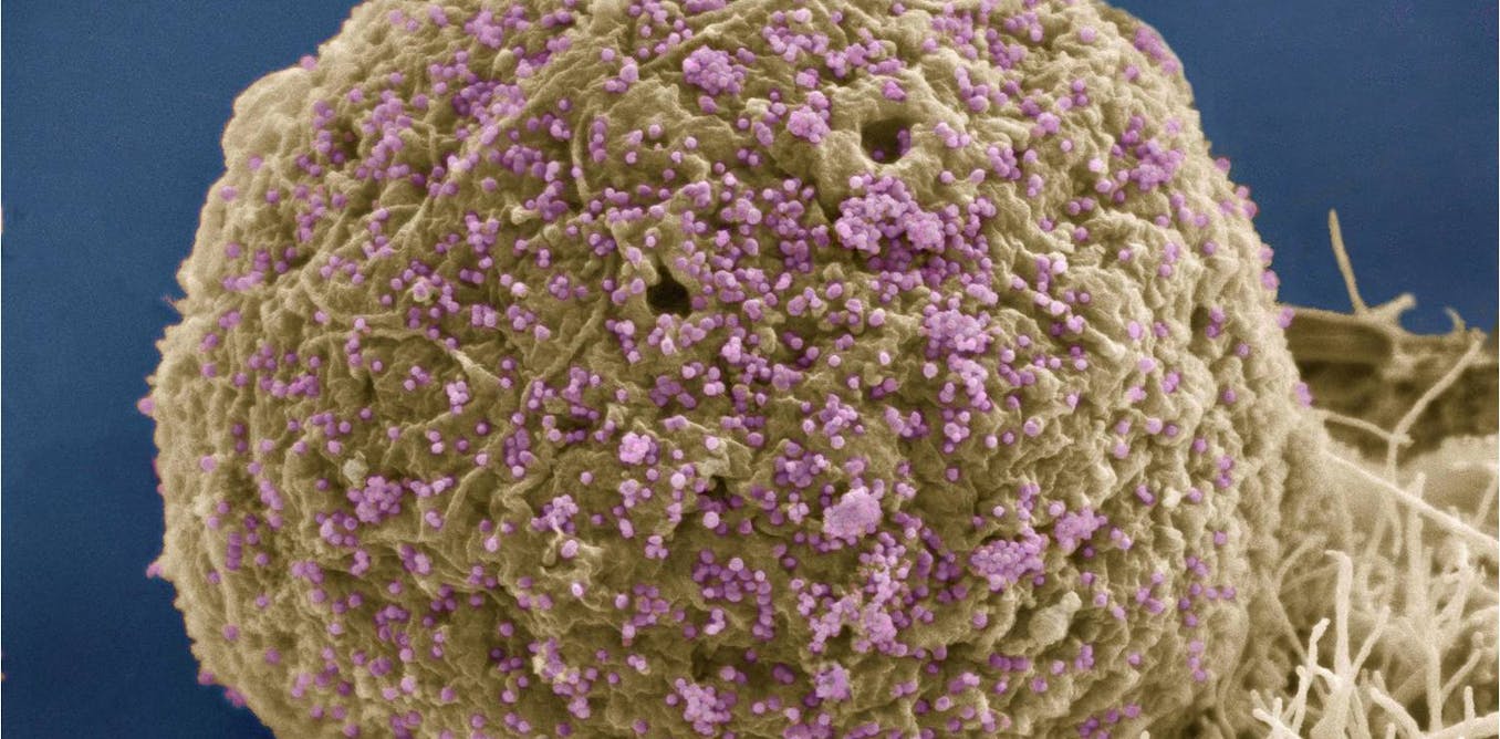 Human immunodeficiency. ВИЧ И СПИД под микроскопом. Вирусы под микроскопом. Вирус ВИЧ под микроскопом. Вирус в микроскопе.