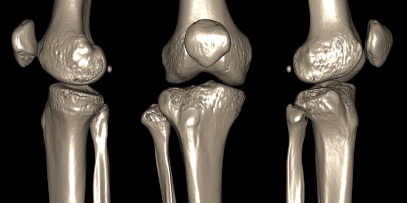 What makes joints pop and crack and is it a sign of disease?