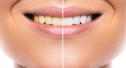 Tooth Whitening Don T Gamble With Your Teeth