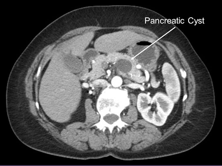 Global study of pancreatic cancer offers possible insights into treatment and early detection